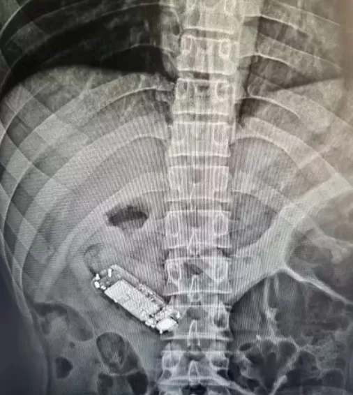 Detento passa por cirurgia após engolir celular em presídio de MT