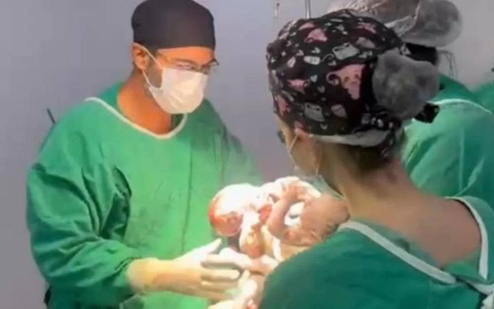 Gêmeos siameses de MT nascem após parto complexo em Goiás