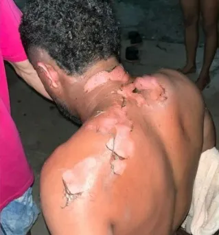 Homem sofre queimaduras após esposa atear fogo durante briga em Sorriso